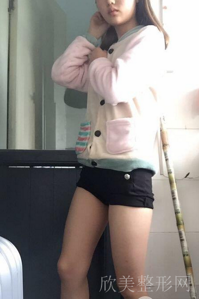 重庆军美抽脂怎么样?医院简介-MM术前术后案例分享
