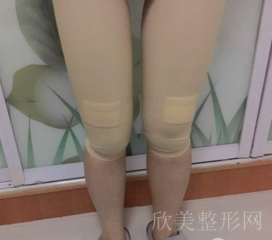 重庆军美抽脂怎么样?医院简介-MM术前术后案例分享