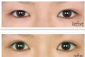 武汉涵美陈娟做眼部整形项目怎么样?顾客评价好不好?