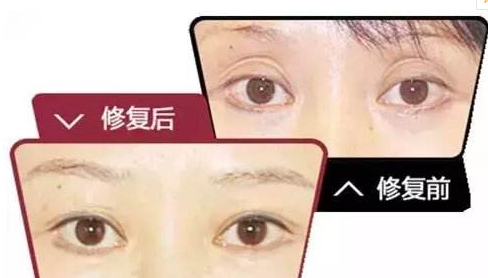 武汉哪里做双眼皮修复效果好?艾美樊辉华医生怎么样?