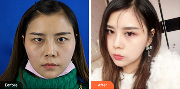 深圳美莱双眼皮手术哪个医生比较好?医生简介-案例分享