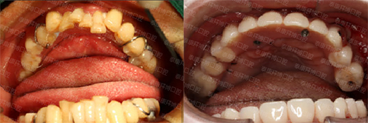 上海拜博口腔黎强不植骨,精准快速种牙治好了患者多年的半口牙缺失