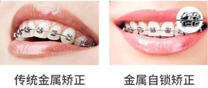 为什么说成年人之后千万别整牙,上海口腔医生来告诉你，并附上2020年价格