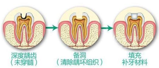 上海九院补牙需要多少钱？附上2020年九院口腔科价目表