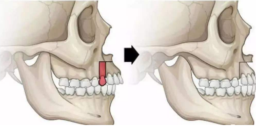 骨性突嘴需要做正颌手术
