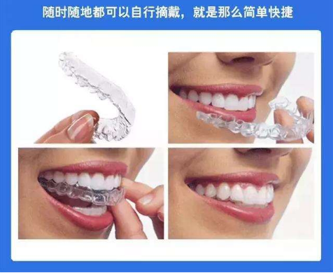 上海哪里矫正牙齿便宜又好