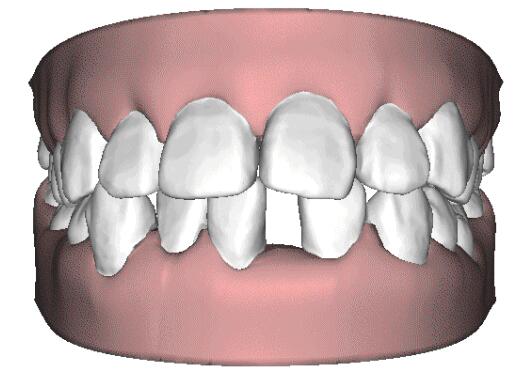 牙齿稀疏怎么办？改怎么通过牙齿矫正来改善牙齿不整齐的问题