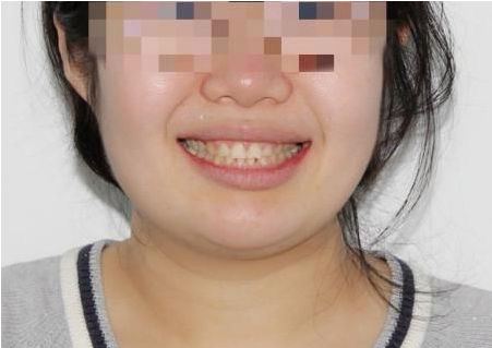 30岁整牙很后悔?牙齿矫正30岁需要注意什么?#上海整牙