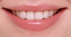 戴牙套矫正牙齿一般要多少钱呢？