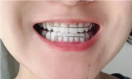 牙齿矫正的你们后悔了吗?分享我的整牙经历