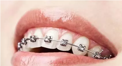 拔牙和矫正牙齿哪个更痛苦?#你应该知道的整牙知识