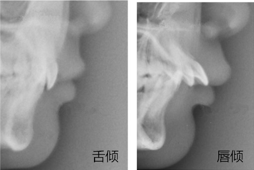 标准的牙齿咬合图片