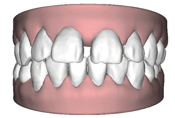 牙齿矫正会导致牙齿松动吗