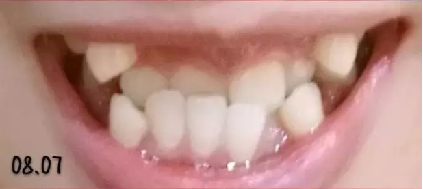 牙齿矫正1个月效果