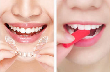 隐形牙齿矫正效果如何?这是你想知道的隐形牙齿矫正的知识吗?