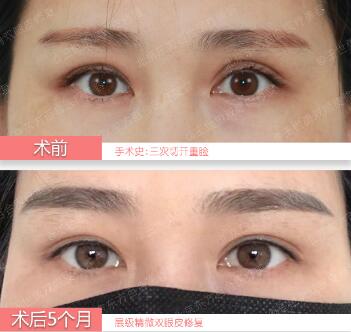 中国眼部修复较好人国内高级修复双眼皮失败的图片案例