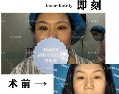 中国眼部修复较好人国内高级修复双眼皮失败的图片案例