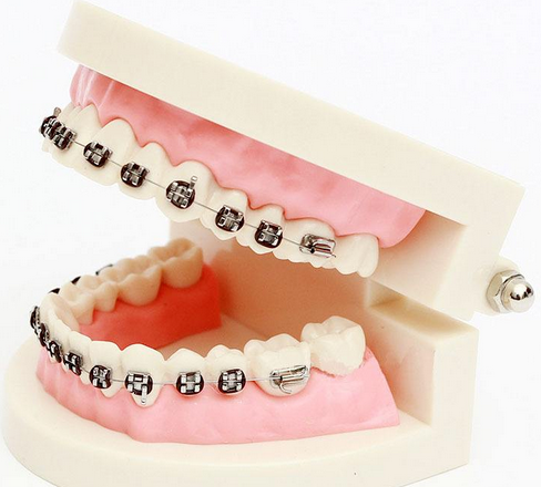 牙齿矫正真的安全吗