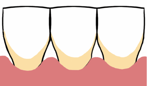 牙齿矫正的危害是什么