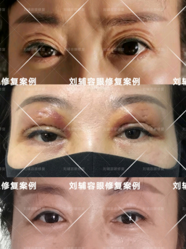 成都刘辅容双眼皮修复怎么样+[刘辅蓉案例]附上2020年眼修复价格表