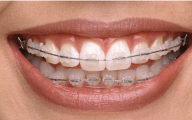 牙齿矫正是怎样矫正的?什么过程?