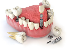 一个良医的忠告：为什么牙医不建议种牙?