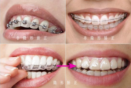 大连矫正牙齿#牙齿矫正要几年才算正常？