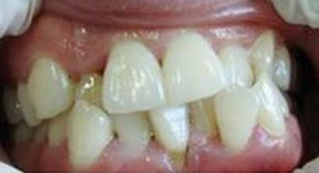 大连牙齿矫正#牙齿不齐隐形矫正需要多久