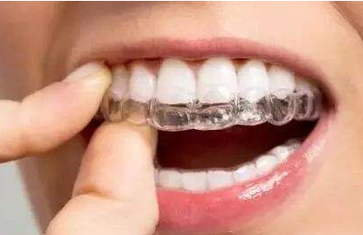 一般牙齿矫正需要多久?为什么差异如此大