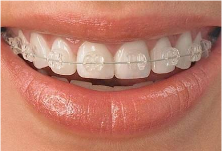 上海牙齿矫正多少钱?价格受什么影响?