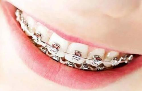 在上海牙齿整形需要多少钱?