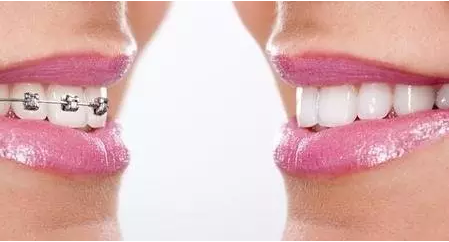 牙齿矫正对以后老了有什么影响?牙齿矫正的十大误区