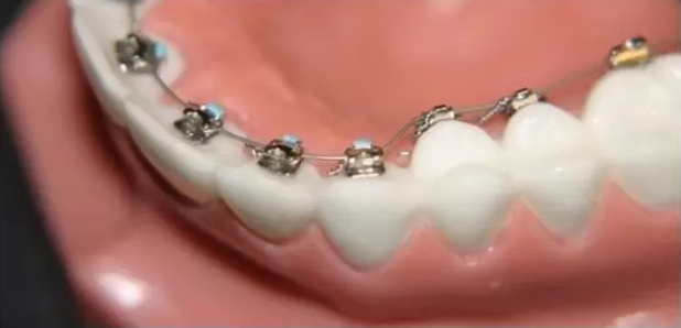 牙齿矫正需要注意什么