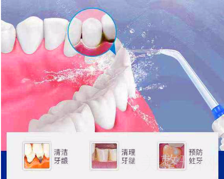 洗牙的利弊分析