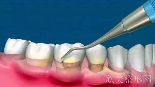 洗牙的利弊分析