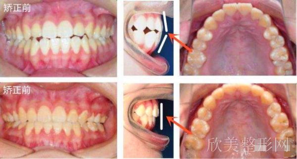 天津口腔医院牙齿矫正案例