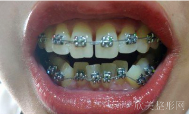 北京牙管家口腔医院靠谱吗?分享我的种牙和正畸案例