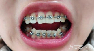 北京牙管家口腔医院靠谱吗?分享我的种牙和正畸案例