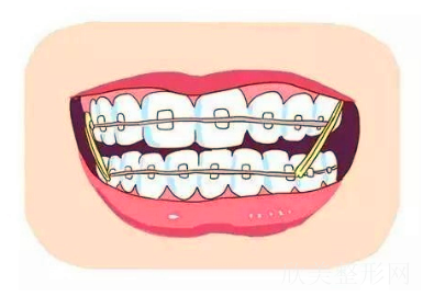 牙齿矫正过程中的橡皮筋有什么作用?