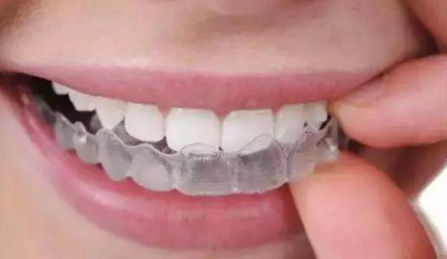 矫正牙齿一般需要多少钱?矫正牙齿的方式有哪些?