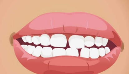 牙齿矫正传说中的“副作用”有哪些?