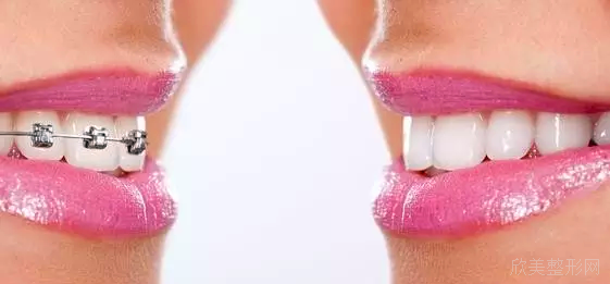 牙齿矫正过程中需要注意什么