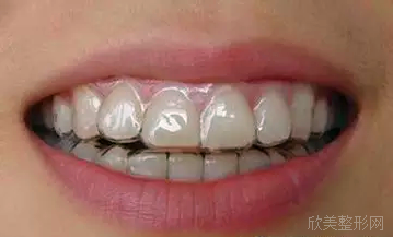 牙齿矫正过程中的8大注意事项