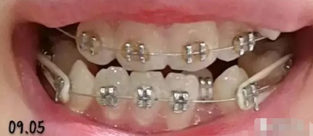 矫正牙齿一个月有变化吗