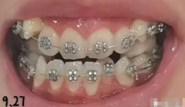 矫正牙齿一个月有变化吗