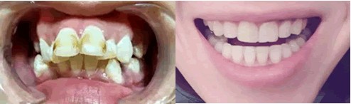 牙齿矫正一到十二月的变化图