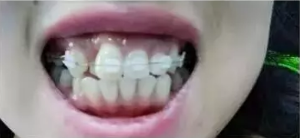 牙齿矫正一年有变化吗