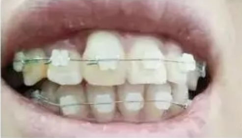 牙齿矫正一年有变化吗