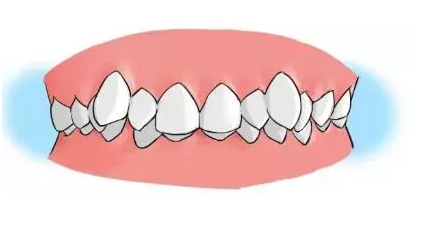 哪些牙齿情况需要矫正?