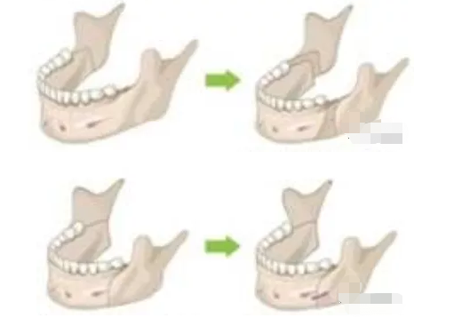 牙齿矫正真的能改变脸型吗